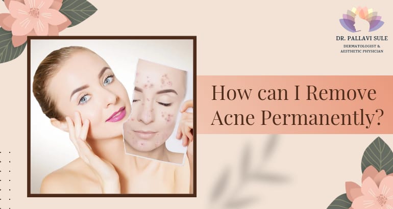 How Can I Remove Acne Permanently