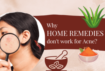 Why Home Remedies Do not Work for Acne?