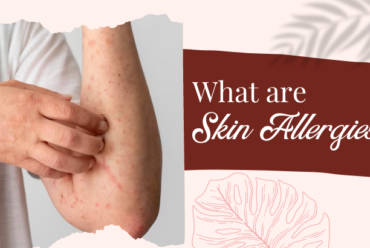 What are Skin Allergies?