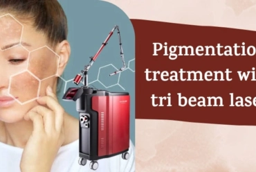 Pigmentation treatment with tri beam laser