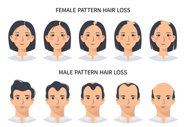 Female and Male Hair loss stages