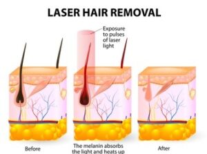 laser hair removal treatment