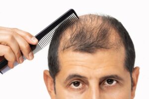 Hair Loss in Men