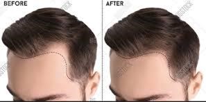 Men hair fall treatment